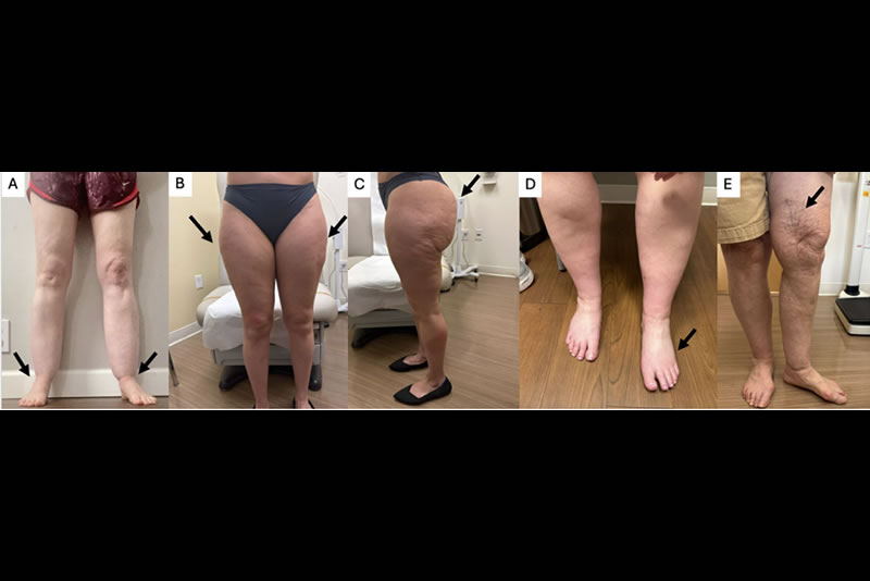 Comprehensive Approach to Management of Lipedema