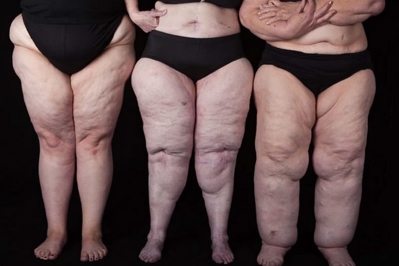 Lipedema: Progress, Challenges, and the Road Ahead