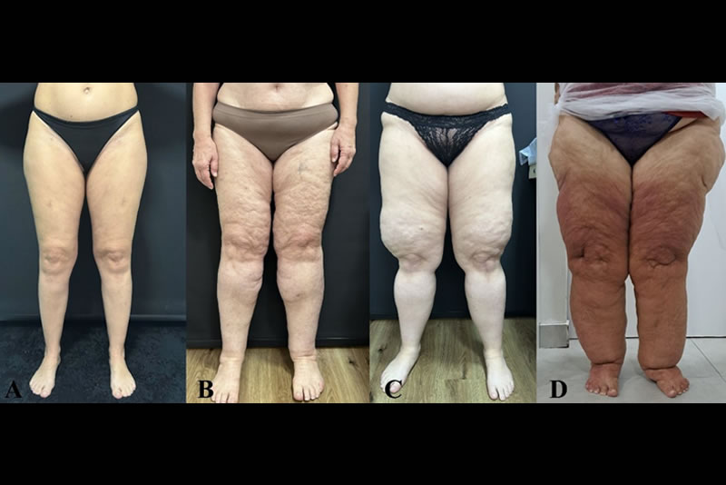 Lipedema: exploring pathophysiology and treatment strategies – state of the art